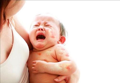 Thực Đơn Cho Bé Bị Dị Ứng Sữa Bò: Thay Thế Bằng Gì? 3 thực đơn cho bé bị dị ứng