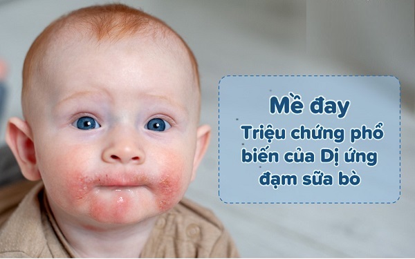 Thực Đơn Cho Bé Bị Dị Ứng Sữa Bò: Thay Thế Bằng Gì? 2 thực đơn cho bé bị dị ứng